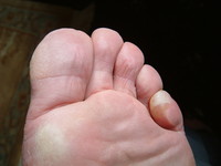 Blisters