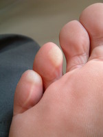 Blisters