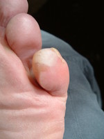 Blisters