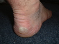 Blisters on Mark's right foot after the first day of the Cotswold Way