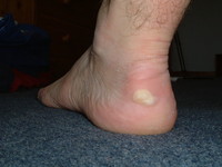 Blisters on Mark's left foot after the first day of the Cotswold Way